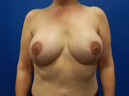 Breast Revision Before & After Patient #1975