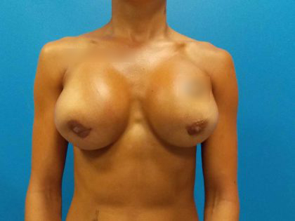Breast Revision Before & After Patient #1912