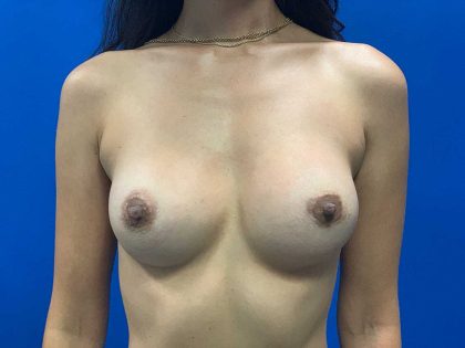 Breast Revision Before & After Patient #1916