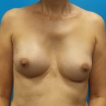 Breast Revision Before & After Patient #1918