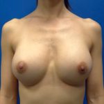 Breast Augmentation Before & After Patient #1809