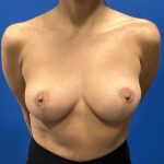 Breast Explant Before & After Patient #2041