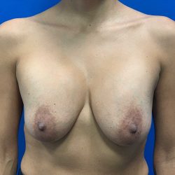 Breast Explant Before & After Patient #2041