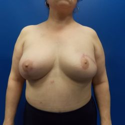 Local Flap Breast Reconstruction Before & After Patient #2056