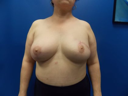 Local Flap Breast Reconstruction Before & After Patient #2056