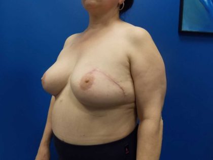 Local Flap Breast Reconstruction Before & After Patient #2056