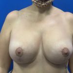 Breast Lift & Augmentation Before & After Patient #2051