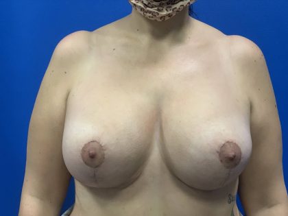 Breast Lift & Augmentation Before & After Patient #2051