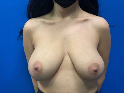 Breast Lift Before & After Patient #1998