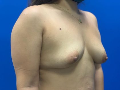 Breast Lift & Augmentation Before & After Patient #2047