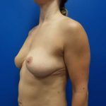 Breast Lift & Augmentation Before & After Patient #2049
