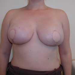 Latissimus Flap with Implant Before & After Patient #2064