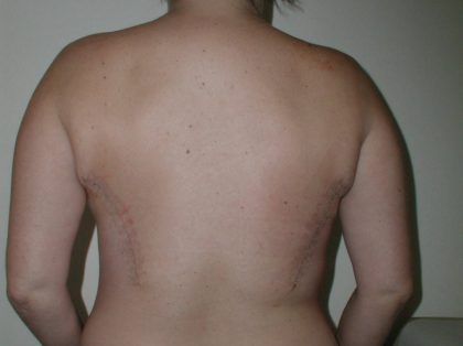 Latissimus Flap with Implant Before & After Patient #2064