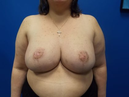 Breast Reduction Before & After Patient #2073