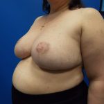 Breast Reduction Before & After Patient #2073
