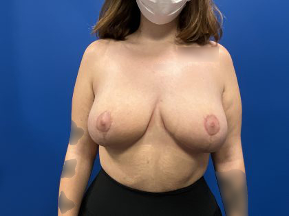 Breast Reduction Before & After Patient #2074