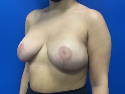 Breast Reduction Before & After Patient #2075