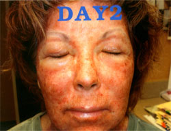 CO2 Laser Before & After Patient #1053