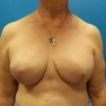 Direct to Implant Breast Reconstruction Before & After Patient #2060