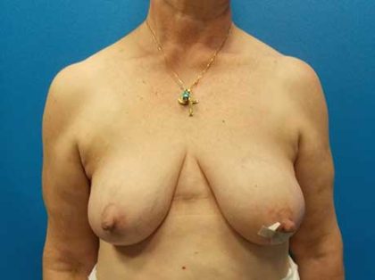 Direct to Implant Breast Reconstruction Before & After Patient #2060