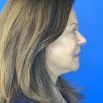 Face & Neck Lift Before & After Patient #2097