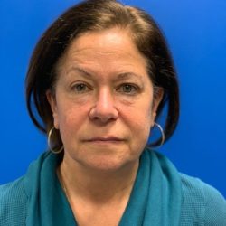 Face & Neck Lift Before & After Patient #2097