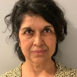 Face & Neck Lift Before & After Patient #2094