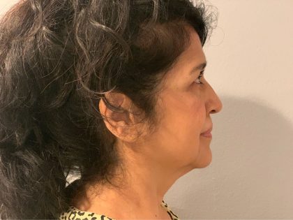 Face & Neck Lift Before & After Patient #2094