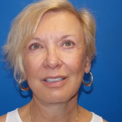 Face & Neck Lift Before & After Patient #2103