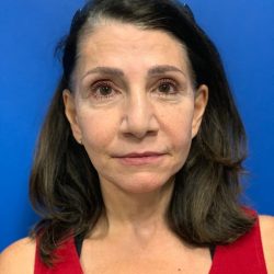 Brow Lift Before & After Patient #2354