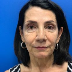 Brow Lift Before & After Patient #2354