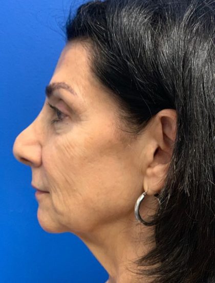 Brow Lift Before & After Patient #2354