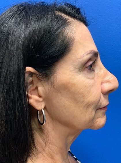 Brow Lift Before & After Patient #2354