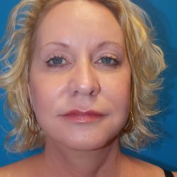 Brow Lift Before & After Patient #2102
