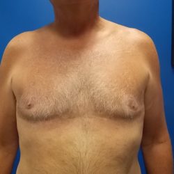 Gynecomastia Before & After Patient #2089