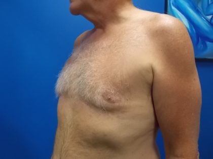 Gynecomastia Before & After Patient #2089