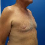 Gynecomastia Before & After Patient #2089