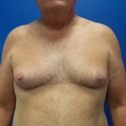Gynecomastia Before & After Patient #2089