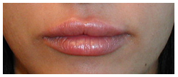Juvederm Before & After Patient #1070
