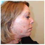 Laser Removal Before & After Patient #1083