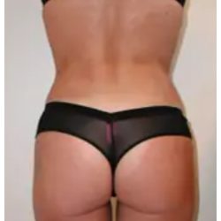 Liposuction Before & After Patient #1032