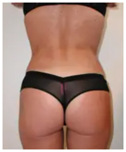 Liposuction Before & After Patient #1032