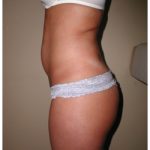 Liposuction Before & After Patient #1032