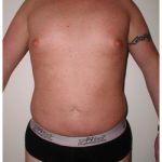 Liposuction Before & After Patient #1033