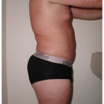 Liposuction Before & After Patient #1033