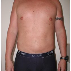 Liposuction Before & After Patient #1033