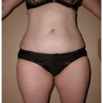 Liposuction Before & After Patient #1034