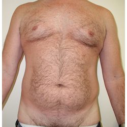 Liposuction Before & After Patient #1035
