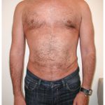 Liposuction Before & After Patient #1035