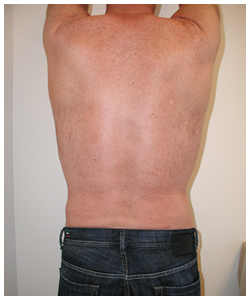 Liposuction Before & After Patient #1035